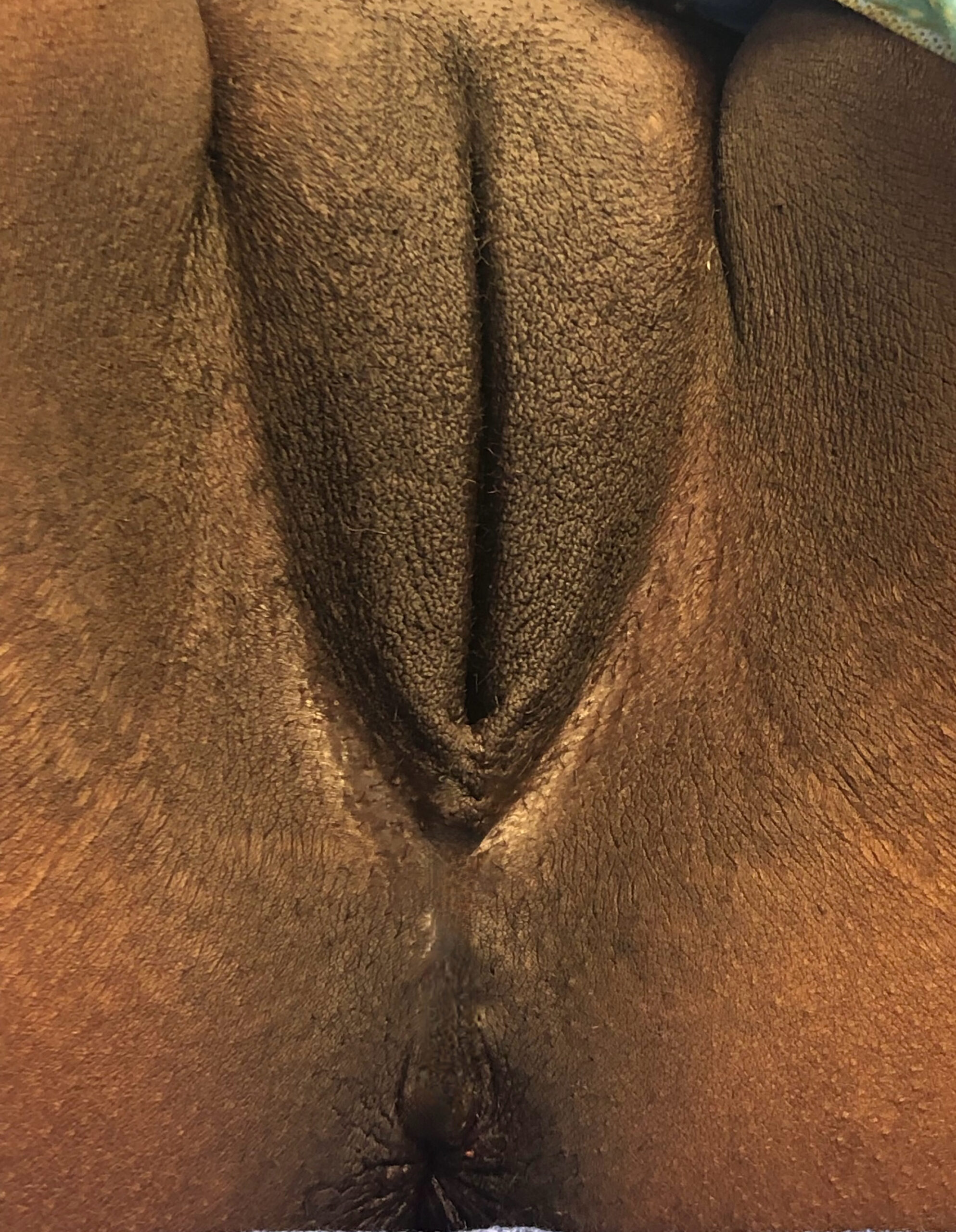 Labia Majora Aumentation 4 After