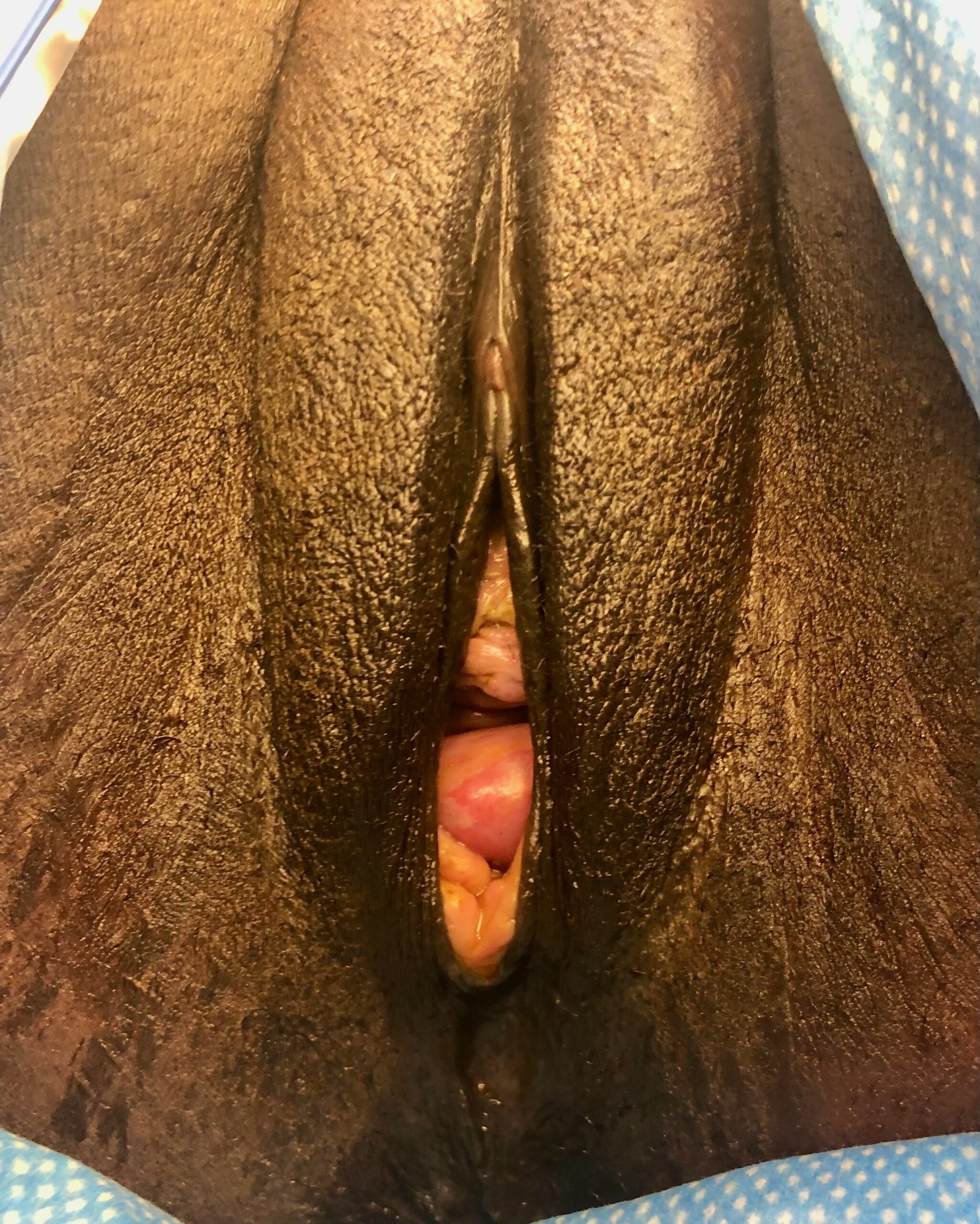 Labia Majora Aumentation 4 Before