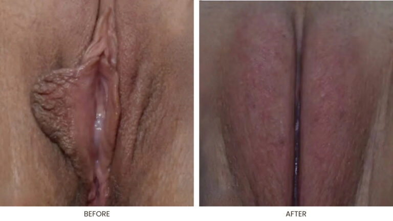 Laser Labia Minoraplasty
