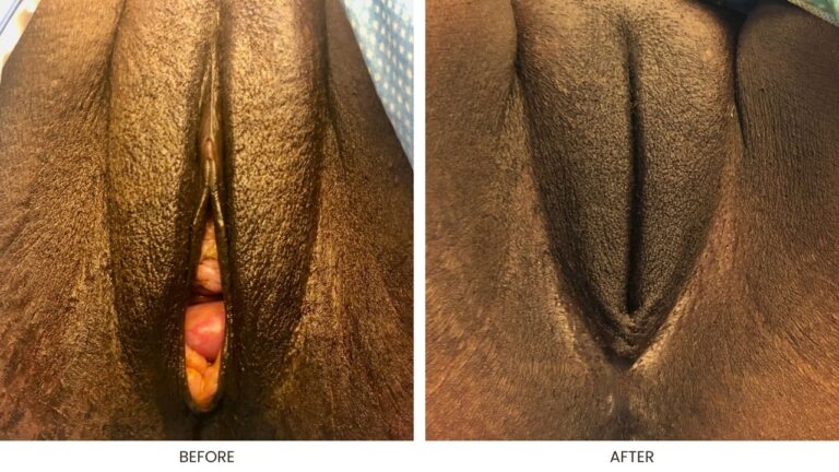 Vaginoplasty