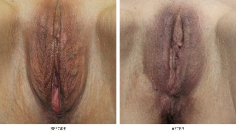 Labia Majoraplasty