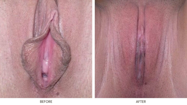 Labia Minoraplasty